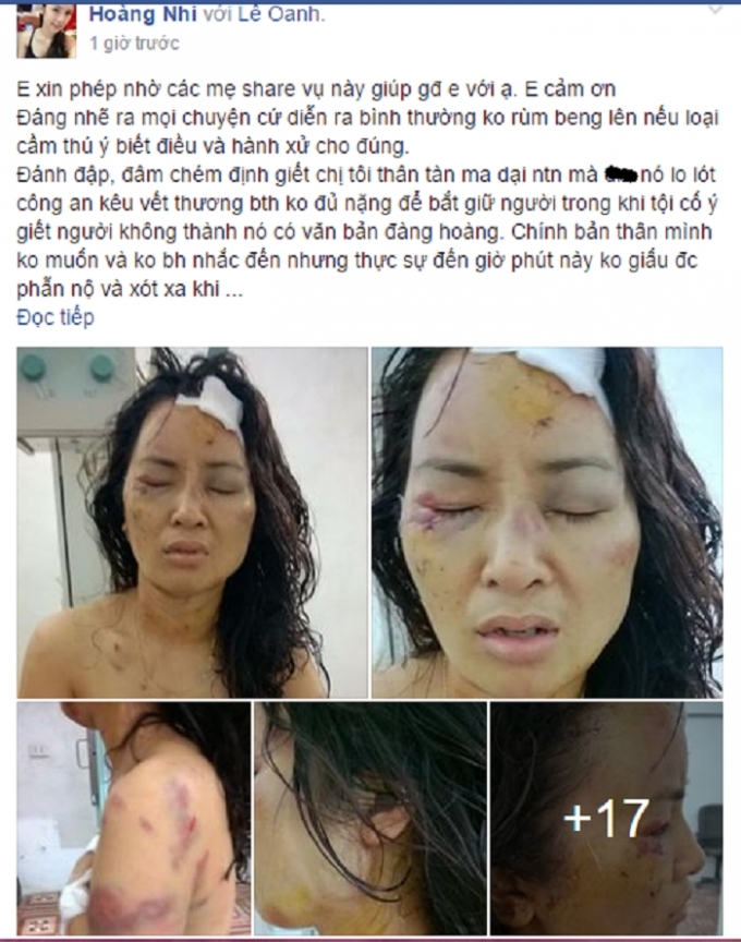 H&igrave;nh ảnh người phụ nữ với những vết thương t&iacute;ch chi ch&iacute;t tr&ecirc;n người (Nguồn: Facebook).