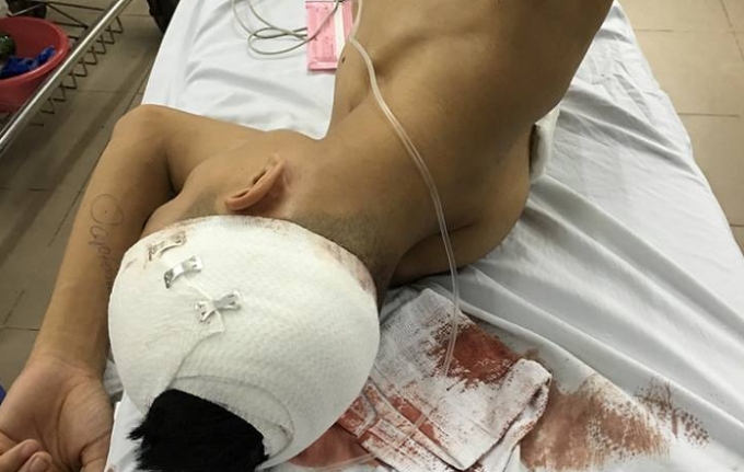 Một trong ba nạn nh&acirc;n đang được điều trị tại bệnh viện Việt Đức.
