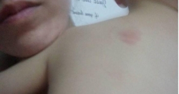 Bé trai 20 tháng tuổi ở Hà Nội bị cắn tím lưng khi trở về từ trường mầm non