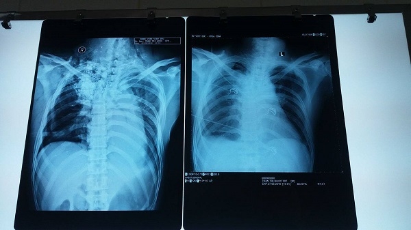 Phim chụp X-Quang của bệnh nh&acirc;n Trần Tr&iacute; Quốc sau khi phẫu thuật lần 2.