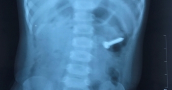 Nội soi phát hiện đinh xoắn ốc dài 3cm trong dạ dày bé gái 2 tuổi