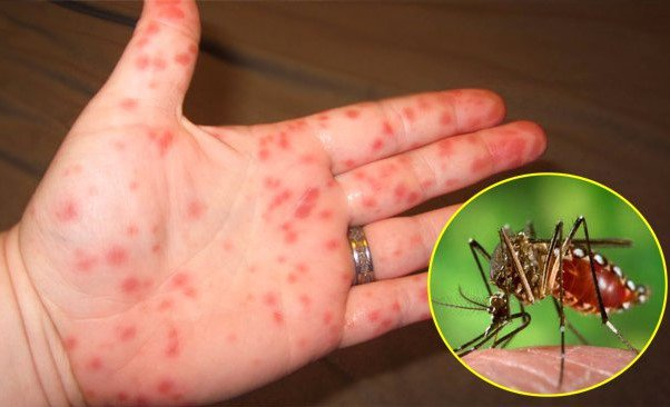 Cách phân biệt sốt xuất huyết với sốt virus thông thường