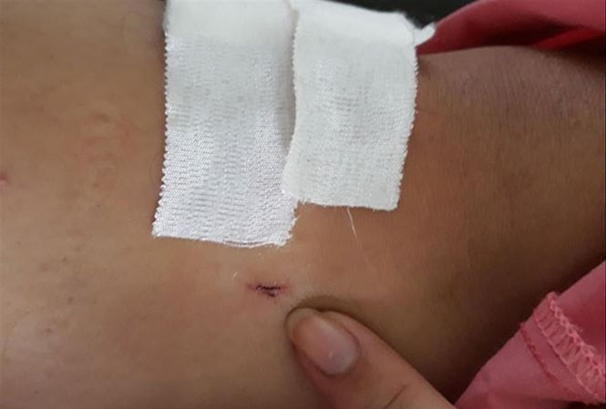 Hình ảnh vết khoan ở chân của bệnh nhân