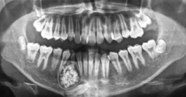 Lấy gần 100 chiếc răng trong khối u răng của bé trai 13 tuổi