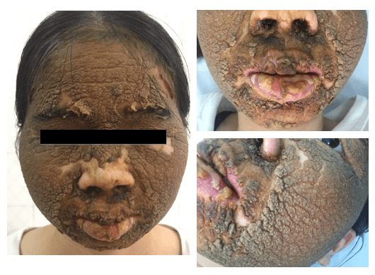 Gương mặt của Lan bị viêm da nặng khi đến khám tại Bệnh viện Da liễu Trung Ương ngày 7/6/2019