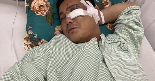 Bắc Giang: Người đàn ông bị nhóm thanh niên lao vào hành hung gãy xương gò má, khâu 28 mũi