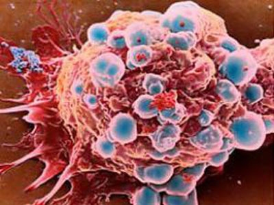 Khám phá bất ngờ: Tế bào ung thư cần mỡ để phát triển