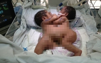 Hai bé song sinh dính liền ở Hà Giang đã tử vong trên đường về quê