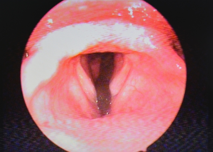 H&igrave;nh ảnh nội soi cho thấy con đỉa d&agrave;i 7cm đang sống trong đường thở của bệnh nh&acirc;n.