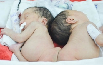Thông tin mới nhất về hai bé song sinh dính liền mông, không có hậu môn