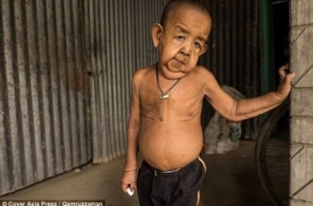 Cậu bé 4 tuổi mang ngoại hình ông lão 80 vì mắc bệnh lạ