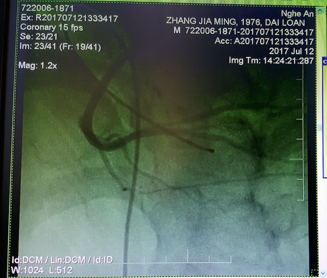 H&igrave;nh ảnh chụp mạch cho thấy, động mạch v&agrave;nh phải của bệnh nh&acirc;n hẹp tắc ho&agrave;n to&agrave;n từ RCA-II.