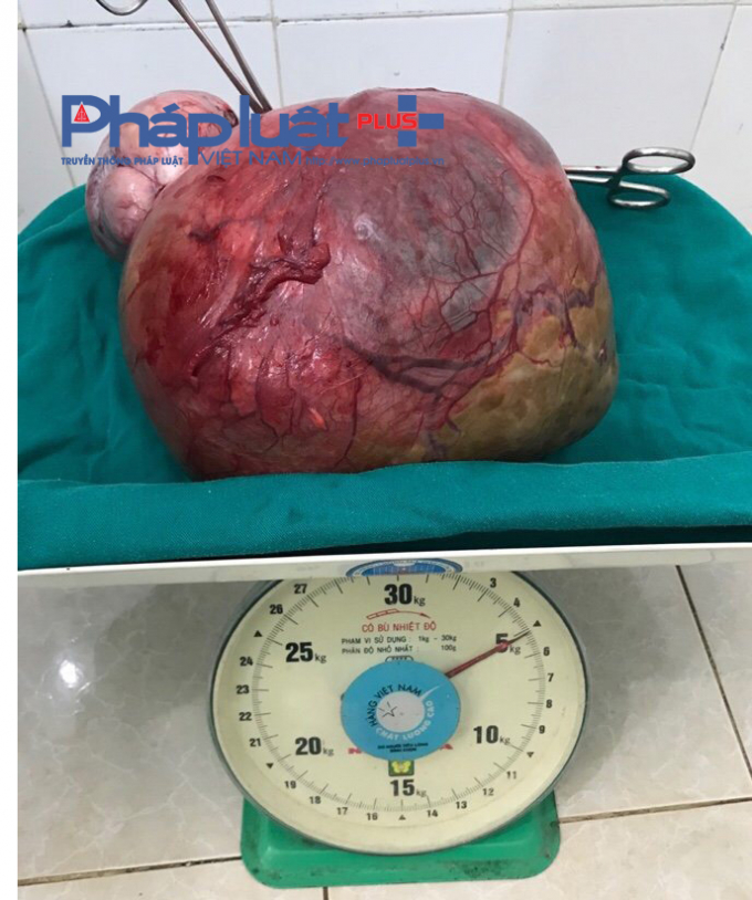 U nang nặng 5kg do c&aacute;c b&aacute;c sĩ Bệnh viện đa khoa huyện Đồng Văn phẫu thuật.