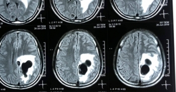 Chụp CT phát hiện 5 ổ sán làm tổ trong não nam bệnh nhân