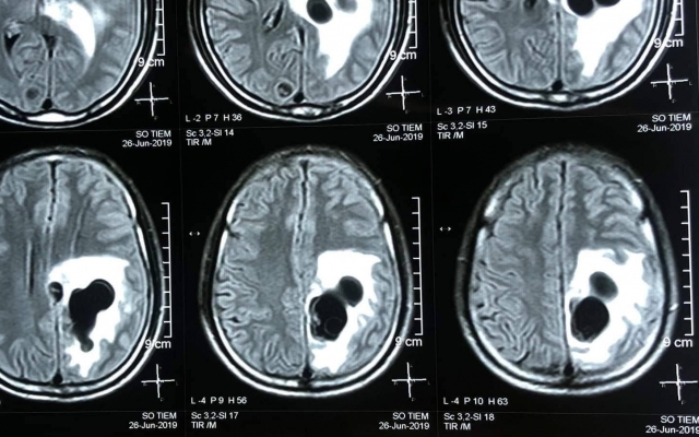 Chụp CT phát hiện 5 ổ sán làm tổ trong não nam bệnh nhân