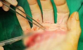 Phẫu thuật cứu bàn tay gần như bị đứt lìa của người thợ nhôm kính