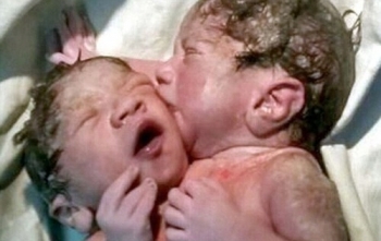 Cặp sinh đôi dính liền nụ hôn khiến các bác sĩ bó tay