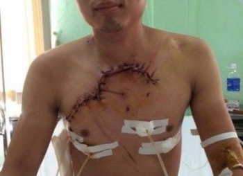BV Việt Đức cứu sống bệnh nhân tai nạn giao thông lộ tim và phổi ra ngoài thành ngực