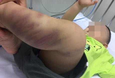 Hà Nội: Khởi tố vụ bé trai 1 tuổi nghi bị bạo hành nghiêm trọng