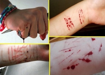 Nữ sinh 21 tuổi hành hạ bản thân bằng những vết cắt