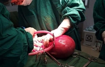 Phẫu thuật khối u xơ tử cung nặng hơn 2kg
