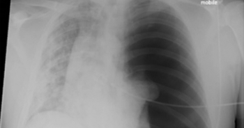 Hình ảnh phổi bị tàn phá của bệnh nhân Covid-19 36 tuổi