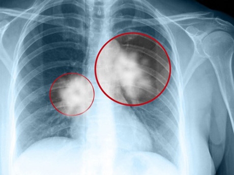 C&oacute; đến 70% người mắc ung thư phổi tử vong trong 1 năm đầu ph&aacute;t hiện.