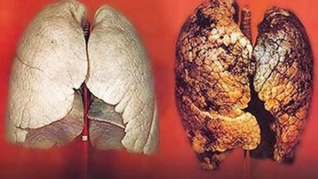 H&igrave;nh ảnh l&aacute; phổi bị ung thư