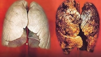 Bị ung thư phổi, phải làm gì để chiến thắng bệnh hiểm nghèo?