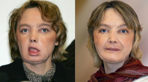 Khu&ocirc;n mặt của Dinoire ngay sau ca phẫu thuật v&agrave;o năm 2005 (tr&aacute;i) v&agrave; năm 2006 (phải). Ảnh:&nbsp;CNN.