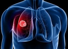 Việt Nam có 20.000 ca mắc ung thư phổi/năm