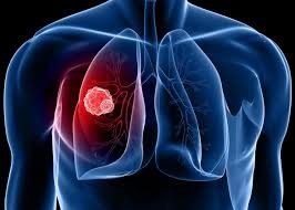 Ung thư phổi l&agrave; một trong mười căn bệnh ung thư thường gặp. Ảnh: minh họa