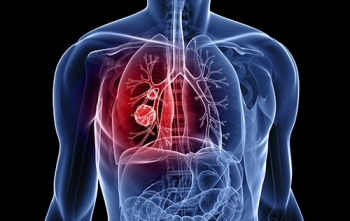 Những tác nhân gây ung thư phổi nguy hiểm hơn hút thuốc lá