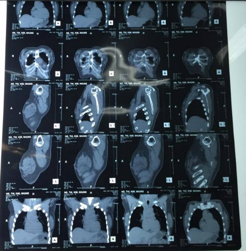Kết quả CT Scan của b&agrave; Hoa. Ảnh: vnexpress.net.