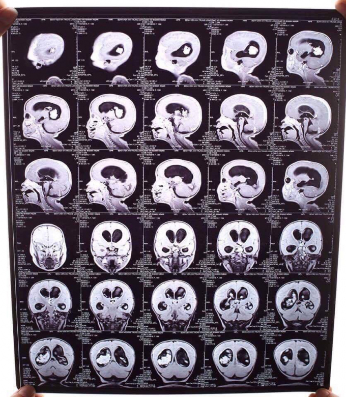 H&igrave;nh ảnh chụp MRI của b&eacute; Kh&aacute;nh Ng&acirc;n.