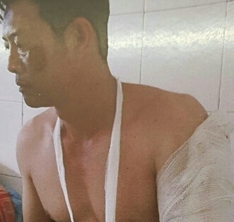 Lâm Đồng: Khởi tố chủ quán nhậu chém gần đứt cánh tay chủ nợ