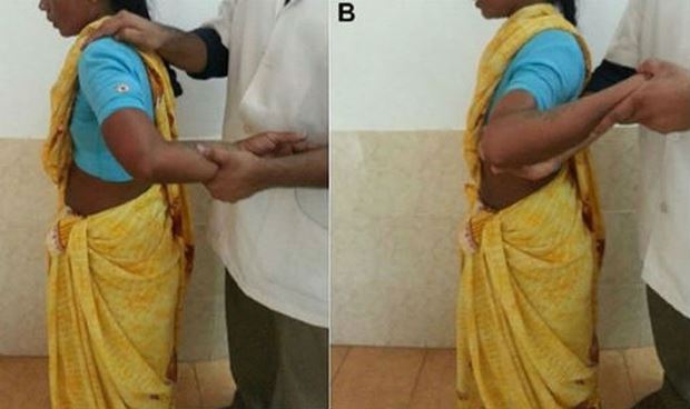Người phụ nữ Ấn Độ mắc hội chứng xương ti&ecirc;u biến dần.