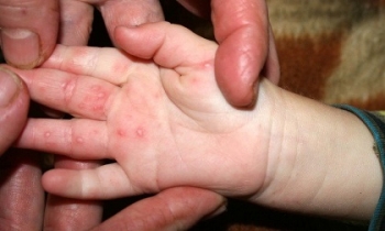Sẽ sớm có vắc xin phòng bệnh tay chân miệng EV71 cho trẻ?