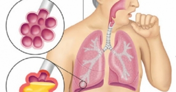 Nấm phổi - căn bệnh nguy hiểm ít người biết