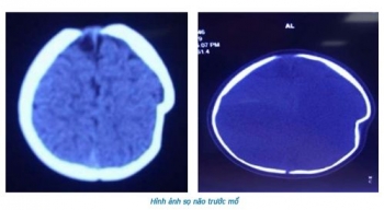 Phú Thọ: Bé 8 tháng tuổi ngã xe lún sọ não