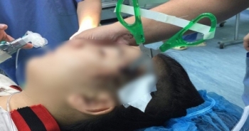 Nghệ An: Học sinh lớp 5 nhập viện với chiếc kéo đâm vào đầu, xuyên qua xương sọ