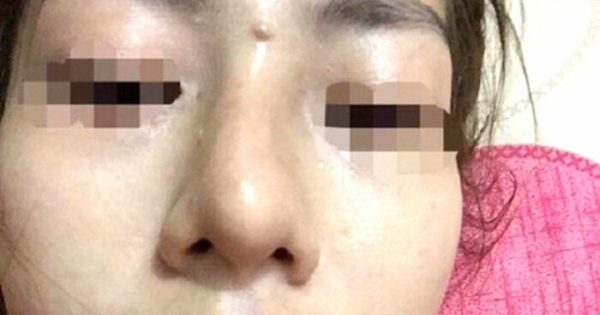 Vụ bé gái 13 tuổi tổn hại 42% sức khỏe khi đi nâng mũi: Khôi phục quyền khiếu nại của gia đình bị hại