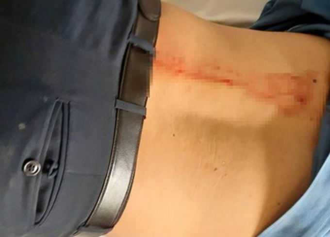 Anh Bình đang điều trị tại bệnh viện Đa khoa tỉnh Đắk Nông với vết thương sau lưng. ( Ảnh: V.L)