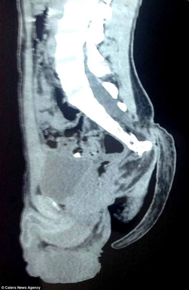 H&igrave;nh ảnh chụp phim x-quang của bệnh nh&acirc;n thể hiện r&otilde; chiếc đu&ocirc;i d&agrave;i