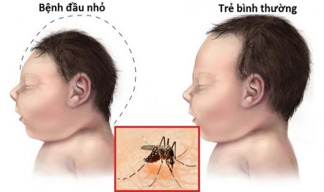 Zika g&acirc;y dị tật đầu nhỏ.
