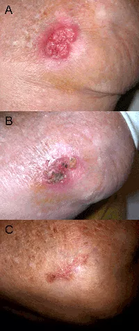 Vi&ecirc;m nhiễm da trong bệnh melioidosis (nguồn: http://diendanykhoa.com)