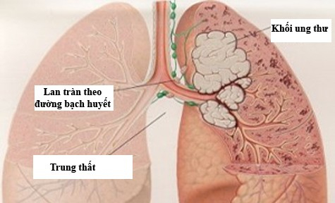 Ung thư phổi l&agrave; một trong 10 bệnh ung thư thường gặp ở cả hai giới.