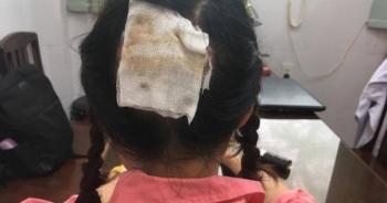 Nữ bác sĩ mất nguyên mảng da đầu sau khi uốn tóc setting
