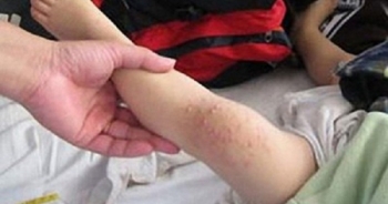 Hà Nội: Gia tăng trẻ mắc cúm A, giám sát tay chân miệng tại 63 bệnh viện