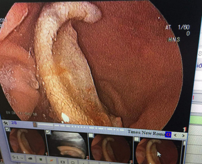 H&igrave;nh ảnh nội soi ph&aacute;t hiện phần v&agrave;nh tai trong bụng của nam sinh kia.